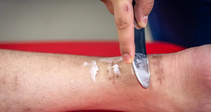 Modern scar treatment options in Chennai